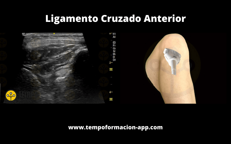 Ligamento Cruzado Anterior Sonda Ecografía.png